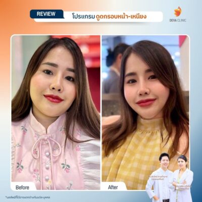 รีวิวดูดหน้า เหนียง 02