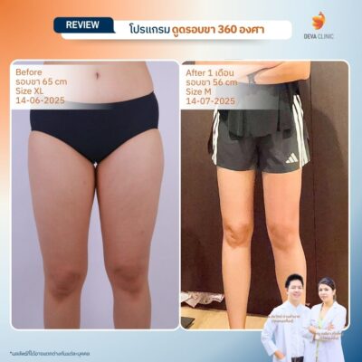 รีวิวลดขาเบียด ดูดไขมันขาใน 06