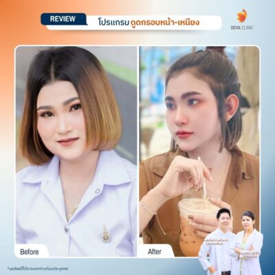 รีวิวดูดหน้า เหนียง 01