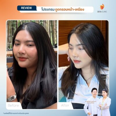 รีวิวผลลัพธ์ ดูดไขมันคาง ราคา 09