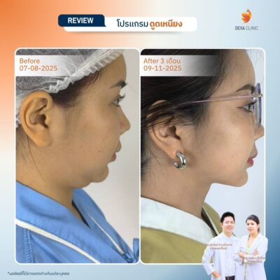 รีวิวผลลัพธ์ ดูดไขมันคาง ราคา 15