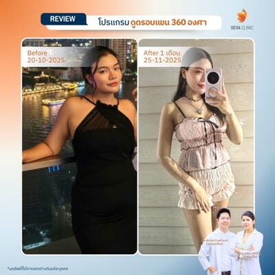 รีวิวเคสแก้ปัญหาไหล่หนา ปรับสรีระช่วงบนให้ดูเพรียวระหงขึ้นที่ Deva Clinic 09