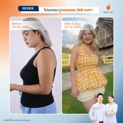 รีวิวเคสแก้ปัญหาไหล่หนา ปรับสรีระช่วงบนให้ดูเพรียวระหงขึ้นที่ Deva Clinic 10