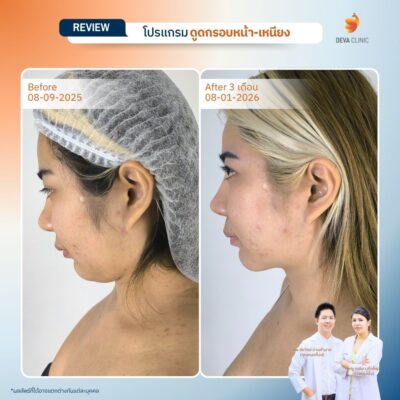รีวิวผลลัพธ์ ดูดไขมันคาง ราคา 16