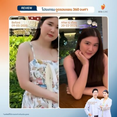 รีวิวเคสแก้ปัญหาไหล่หนา ปรับสรีระช่วงบนให้ดูเพรียวระหงขึ้นที่ Deva Clinic 03