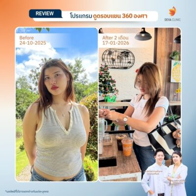 รีวิวเคสแก้ปัญหาไหล่หนา ปรับสรีระช่วงบนให้ดูเพรียวระหงขึ้นที่ Deva Clinic 05