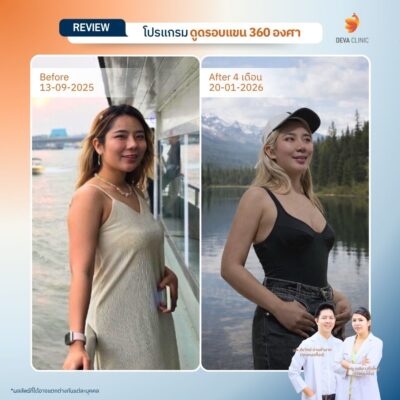 รีวิวเคสแก้ปัญหาไหล่หนา ปรับสรีระช่วงบนให้ดูเพรียวระหงขึ้นที่ Deva Clinic 12