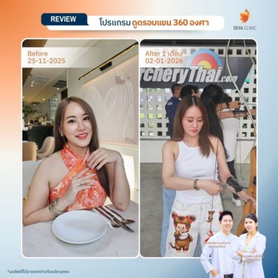 รีวิวเคสแก้ปัญหาไหล่หนา ปรับสรีระช่วงบนให้ดูเพรียวระหงขึ้นที่ Deva Clinic 15