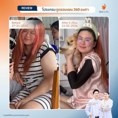 รีวิวเคสแก้ปัญหาไหล่หนา ปรับสรีระช่วงบนให้ดูเพรียวระหงขึ้นที่ Deva Clinic 16