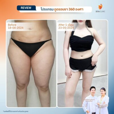รีวิวลดขาเบียด ดูดไขมันขาใน 15