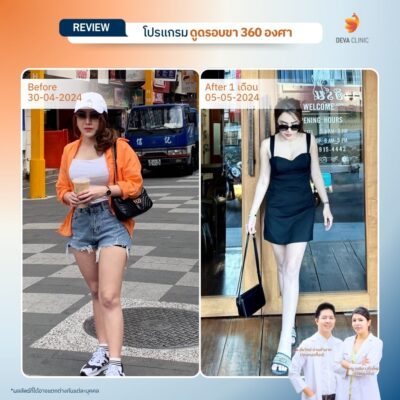 รีวิวลดขาเบียด ดูดไขมันขาใน 08