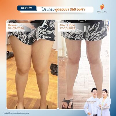 รีวิวลดขาเบียด ดูดไขมันขาใน 05