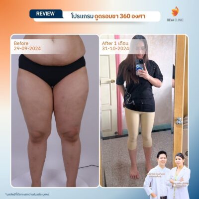 รีวิวลดขาเบียด ดูดไขมันขาใน 14
