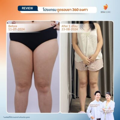 รีวิวลดขาเบียด ดูดไขมันขาใน 04