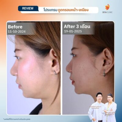 รีวิวผลลัพธ์ ดูดไขมันคาง ราคา 02