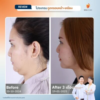 รีวิวดูดหน้า เหนียง 15