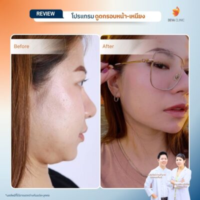 รีวิวดูดหน้า เหนียง 14