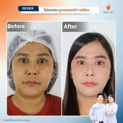 รีวิวดูดหน้า เหนียง 13