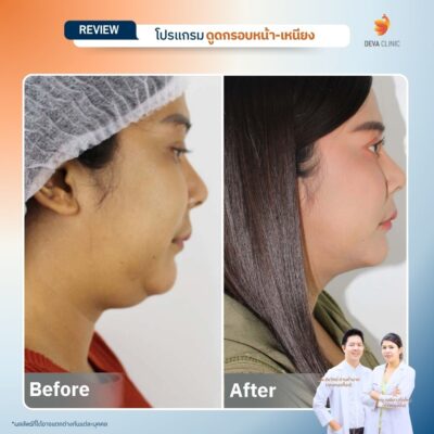 รีวิวดูดหน้า เหนียง 10