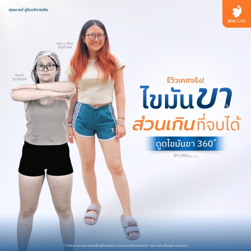 โปรแกรมดูดไขมันต้นขา 360 องศา ดีว่าคลินิก ลาดพร้าว 01
