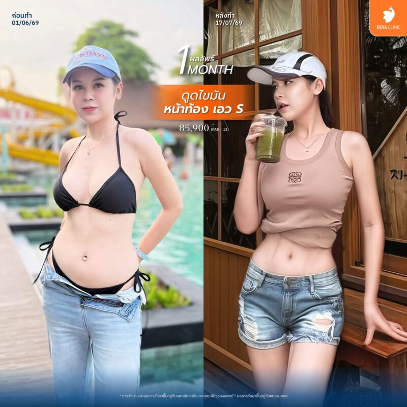 ดูดไขมันหน้าท้องและรอบเอว - Deva Clinic pantip 01
