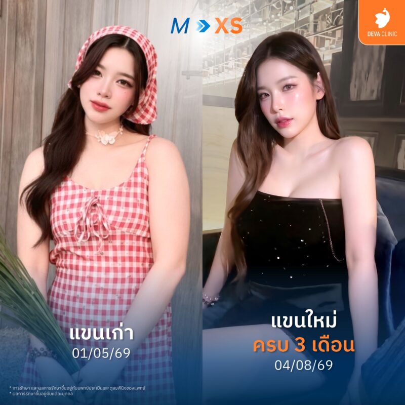 ดูดไขมันหัวไหล่ช่วยให้ใส่เสื้อผ้าสวยขึ้น ลดไซส์เสื้อได้จริงไหม?