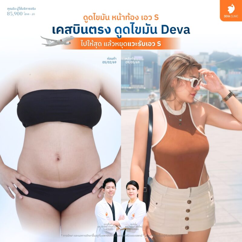 ดูดไขมันหน้าท้อง เอวเอส (S-Line Shaping) - รีวิวคลินิกดูดไขมัน pantip
