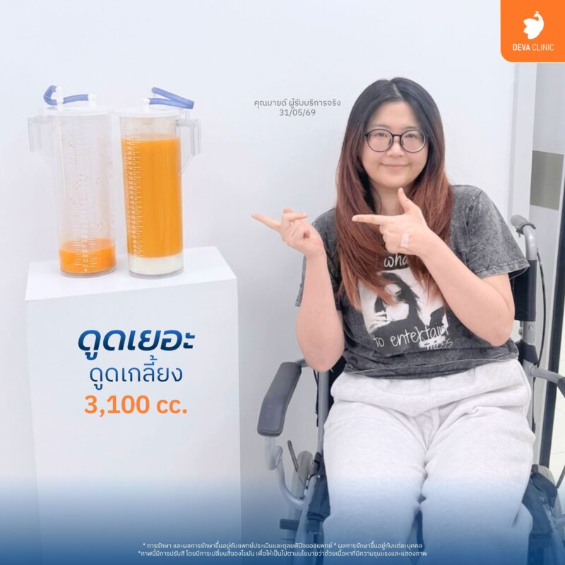 โปรแกรมดูดไขมันต้นขา 360 องศา ดีว่าคลินิก ลาดพร้าว 02
