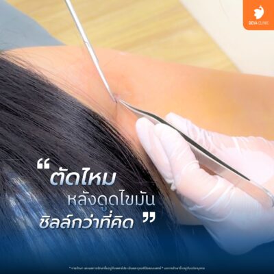 การดูแลหลังการรักษา (Aftercare) ตัดไหม 1