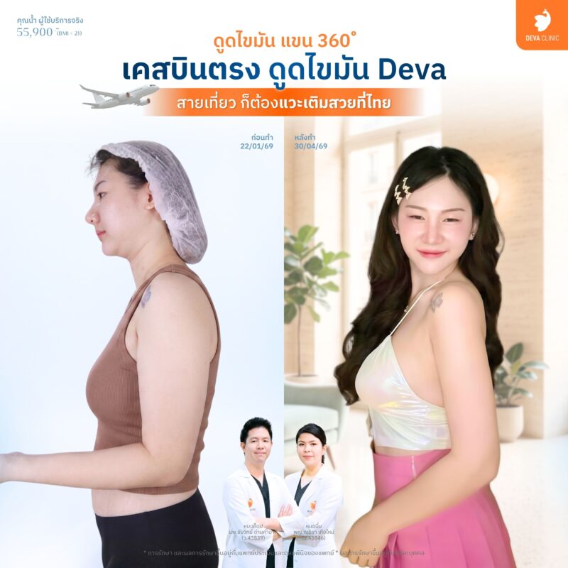 ดูดไขมันต้นแขน - Deva Clinic pantip 03