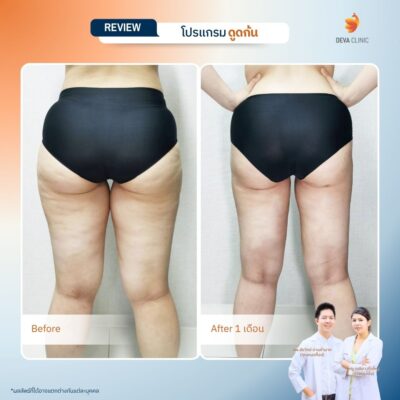 รวมรีวิวเคสดูดไขมันก้น ก่อน-หลัง (Before & After) ที่ Deva Clinic 5