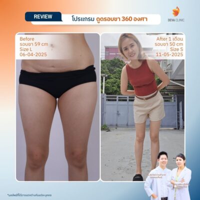 รีวิวลดขาเบียด ดูดไขมันขาใน 12