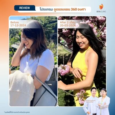 รีวิวเคสแก้ปัญหาไหล่หนา ปรับสรีระช่วงบนให้ดูเพรียวระหงขึ้นที่ Deva Clinic 08