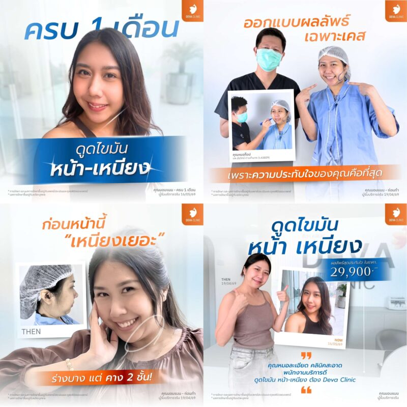 เหนียงและกรอบหน้า (Double Chin & Jawline) - คลินิกดูดไขมันที่ไหนดี 2569