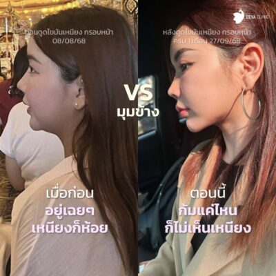 รวมภาพเคสรีวิว Before & After กรอบหน้าคมชัดทุกองศา - คุณออมสิน 2