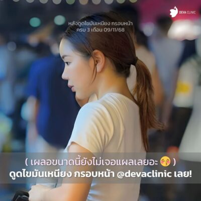 รวมภาพเคสรีวิว Before & After กรอบหน้าคมชัดทุกองศา - คุณออมสิน 4
