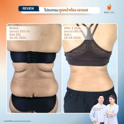 รีวิวดูดไขมันปีกข้าง 4