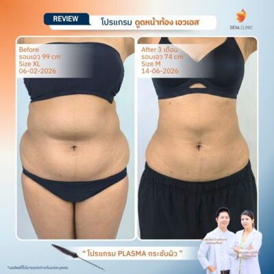 รีวิวดูดไขมันปีกข้าง 6