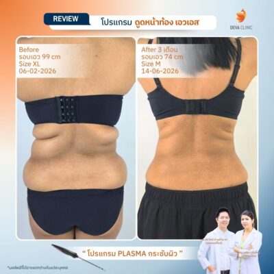 รีวิวดูดไขมันปีกข้าง 5