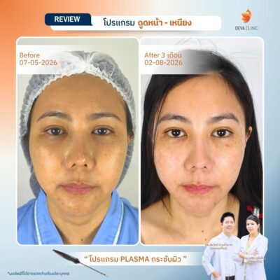รีวิวผลลัพธ์ ดูดไขมันแก้ม ราคา 02