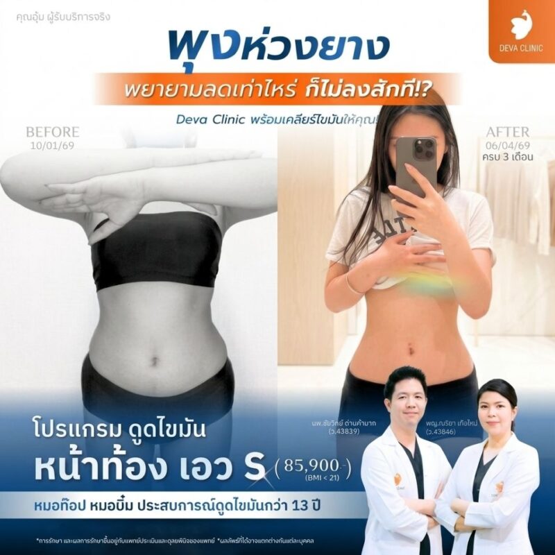 เทคนิคเหลาเอวคอด S-Curve แบบ 360 องศา จัดการไขมันรอบทิศทางได้อย่างไร