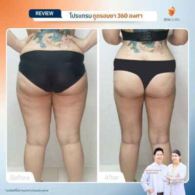 รีวิว Before & After เคสดูดไขมันใต้ก้น 18