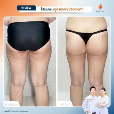 รีวิว Before & After เคสดูดไขมันใต้ก้น 1