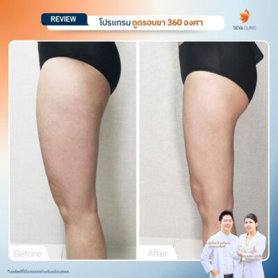 รีวิว Before & After เคสดูดไขมันใต้ก้น 2