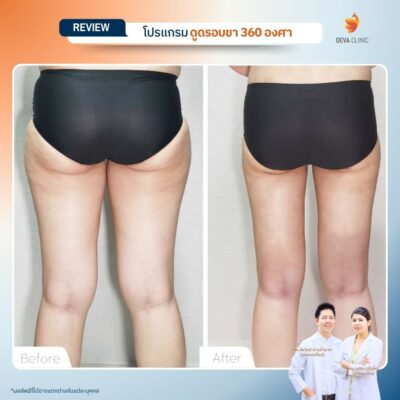 รีวิว Before & After เคสดูดไขมันใต้ก้น 6