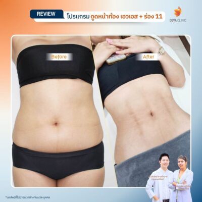 รีวิว ดูดไขมันร่อง 11 3