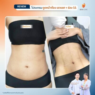 รีวิว ดูดไขมันร่อง 11 2