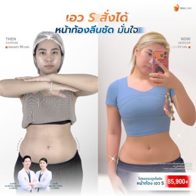 รีวิว Before & After เคสดูดไขมันรอบเอว ปีกข้าง 3