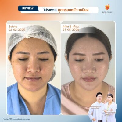 รีวิวผลลัพธ์ ดูดไขมันแก้ม ราคา 01