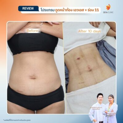 รีวิว ดูดไขมันร่อง 11 5